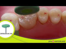 Kit Zirconia Gloss Chairside Jota 22-1441